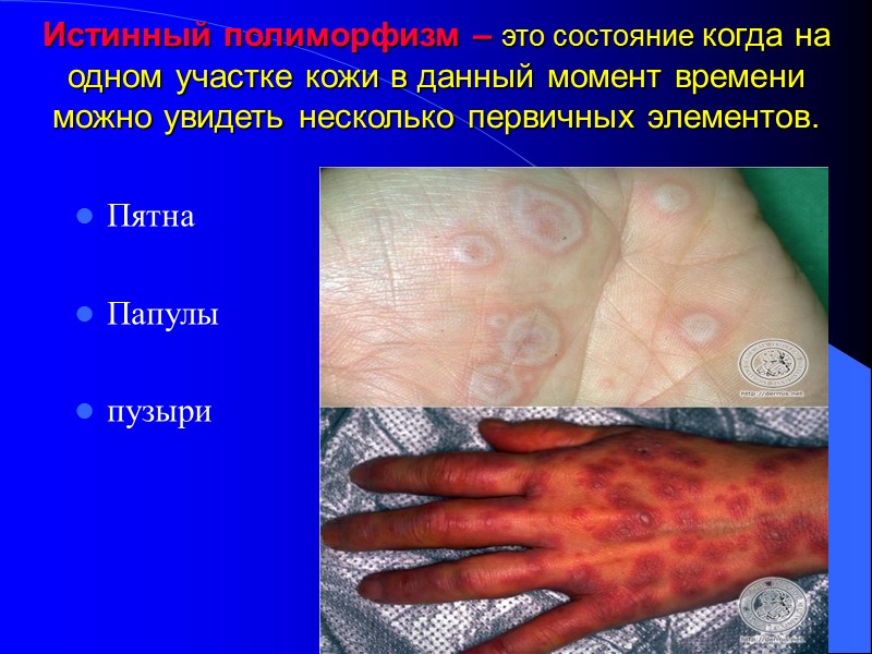 Истинный полиморфизм – это состояние когда на одном участке кожи в данный момент времени